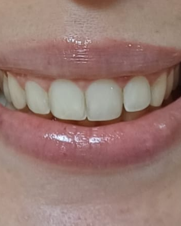 Depois — botox para sorriso gengival